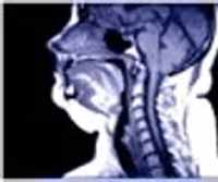 Apneia Obstrutiva do Sono