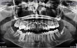 Atraso Na Erupção De Molar Definitivo