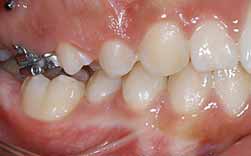 Atraso Na Erupção De Molar Definitivo