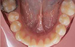 Atraso Na Erupção De Molar Definitivo