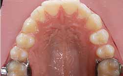 Atraso Na Erupção De Molar Definitivo