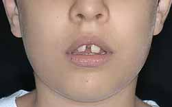 Diastema Interincisivo - Atraso Na Erupção - Falta De Espaço