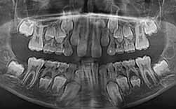 Diastema Interincisivo - Atraso Na Erupção - Falta De Espaço