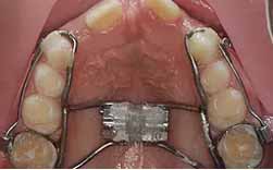 Diastema Interincisivo - Atraso Na Erupção - Falta De Espaço