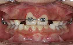 Diastema Interincisivo - Atraso Na Erupção - Falta De Espaço