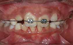 Diastema Interincisivo - Atraso Na Erupção - Falta De Espaço