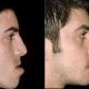 Prognatismo Mandibular