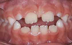 Sucção Lingual - Incisivos Projectados