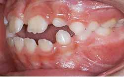 Sucção Lingual - Incisivos Projectados