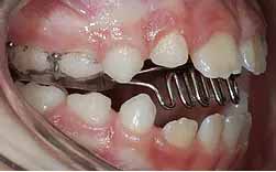 Sucção Lingual - Incisivos Projectados