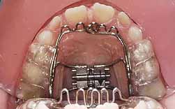 Sucção Lingual - Incisivos Projectados