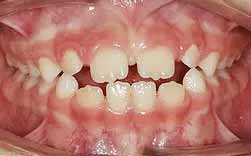 Sucção Lingual - Incisivos Projectados