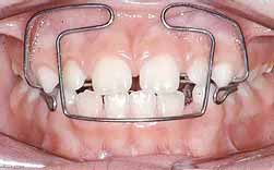 Sucção Lingual - Incisivos Projectados