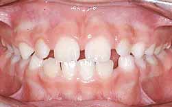 Sucção Lingual - Incisivos Projectados